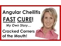 Angular Cheilitis FAST CURE - Gone Quickly