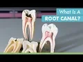 What Is A Root Canal -