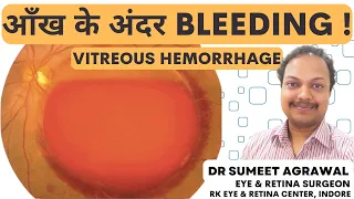 bleeding inside the eye vitreous hemorrhage learn the causes symptoms and treatment 