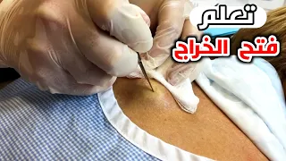 اتعلم فتح الخراج في المنزل او المستشفي Learn The Correct Way To Open An Abscess 