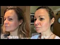 NuFace microcurrent review My before and after results 4 months in