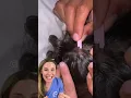 Download Lagu Dermatologist reacts to botfly extraction. Original video credit: the bucket list family. #botfly