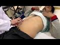 Ascites examination Liver Dr Arvind Kumar