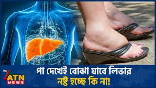 পা ও গোড়ালি ফোলার পেছনে লিভারের মারাত্মক রোগ? | Liver Disease | Swollen Feet | ATN News