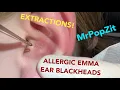 EAR BLACKHEAD EXTRACTIONS on a fellow YouTuber Watch as I clear out her pores on her ear