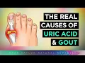 Download Lagu What REALLY Causes Gout \u0026 High Uric Acid?