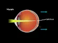 Myopia and Eye Development