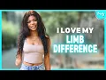 Download Lagu De helft van mijn arm is verdwenen - maar ik zal het nooit verbergen | BORN DIFFERENT