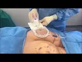 Download Lagu CellFina | Cellulite Treatment | Sarah Yovino MD | Beverly Hills | Ideal Face \u0026 Body
