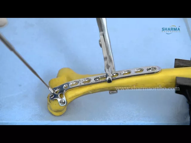 LCP Posterolateral Distal Humerus Plates, with support and LCP Medial Distal Humerus Plate