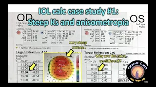 CataractCoach 1525 IOL calc case study steep Ks and anisometropia