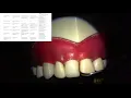 provisional crown assessment