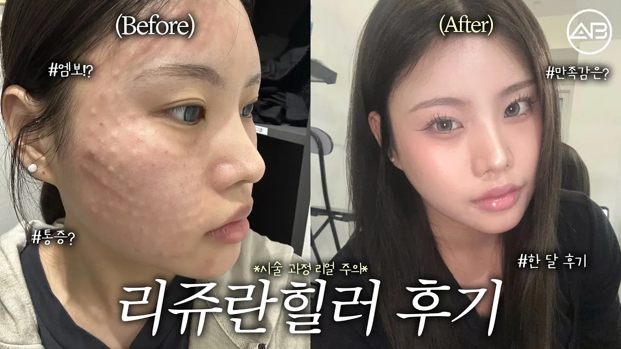 리쥬란이 데일리템인 이유