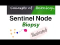 Sentinel node biopsy - A simple way to Understand
