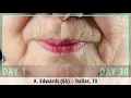 Angellift Before After of Women over 70