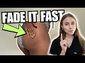 Stretch Marks Body Hyperpigmentation Can Skincare Really Help