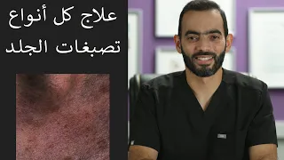 علاج كل أنواع تصبغات الجلد 