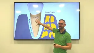 Força Ortodontica Pesada: consequências no periodonto