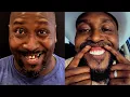 Long-term Review of All-on-4 Don t get them before watching this