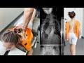 Download Lagu Scoliosis Treatment with Gonstead Chiropractic Care |Ep2| Dr. Rahim