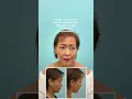 65-year-old 9 months after Deep-Plane Facelift Deep Neck Lift Fat Grafting Blepharoplasty