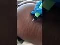 Stretch Marks Inkless Removal Boleyn Treatment Los Angeles