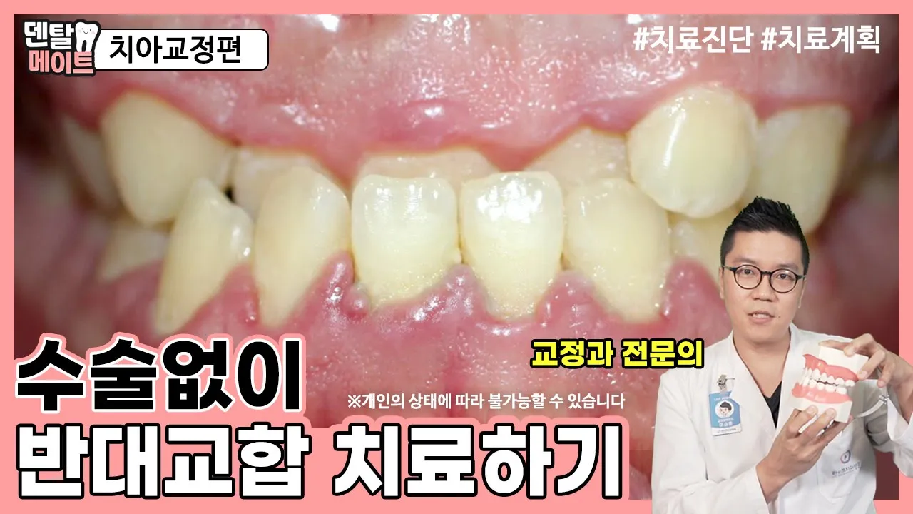치아교정으로 반대교합 치료하는 방법 (원인과 문제점, 치료계획) | 덴탈메이트 - 반대교합과 주걱턱1탄