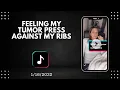 Feeling My Tumor Press Against My Ribs
