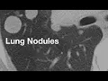 Lung Nodules basics for patients