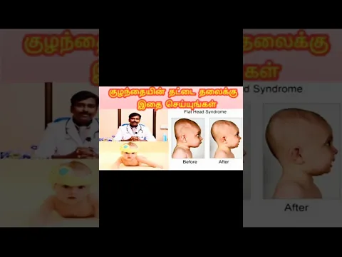 Worried about your baby’s Flat Head? watch this!