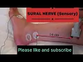SURAL NERVE SURAL NERVE conduction study ncs of sural nerve