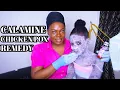 HOW TO APPLY CALAMINE LOTION CHICKEN POX TREATMENT IN CHILDREN REMEDY FOR ITCHY CHICKEN POX