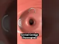 Download Lagu Stitching the cervix to prevent miscarriage (3D animation