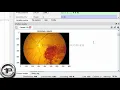 Diabetes Retinopathy Image Segmentation and Classification in Fundus Image using SVM In PYTHON - DIP
