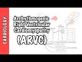Arrhythmogenic right ventricular cardiomyopathy ARVC - pathophysiology investigations treatment