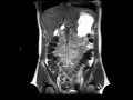 Redundant colon feels like mass in pelvis