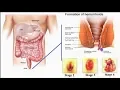 Download Lagu Penyakit Wasir : Obat Wasir Paling Ampuh Tanpa Di operasi