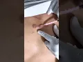 Download Lagu How to treat keloid scar | Keloid Removal Treatment | Remove keloid by injection |  Skinaa Clinic