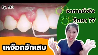 เหงือกอักเสบมีอาการอย่างไรบ้าง