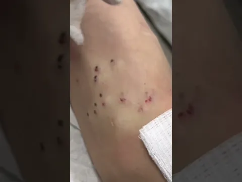 What is Steatocystoma Multiplex? | Dr. Pimple Popper vs. Steatocystomas