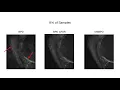 Utilizing the Wavelet Transform s Structure with Compressed Sensing