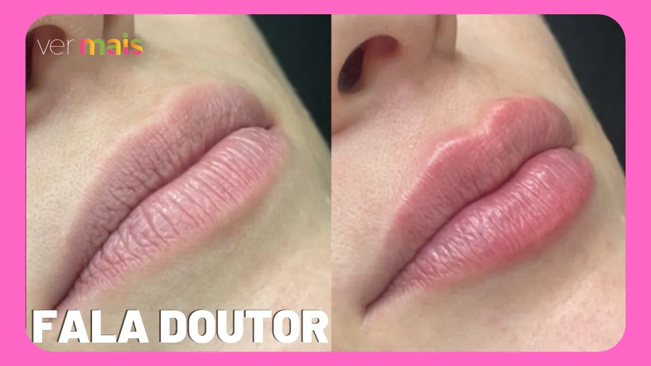 Fala Doutor: saiba como funciona o preenchimento labial