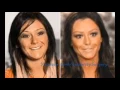 Jwoww Plastic Surgery Before and After