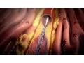 Download Lagu Stent Procedure