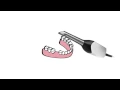 CEREC - Single Visit Dental Restorations