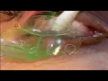 Download Lagu Doctor removes 23 contact lenses from patient's eye