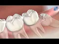 Post-Operative Instructions in Amarillo TX Wisdom Teeth Amarillo Oral Maxillofacial Surgery
