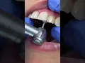 Download Lagu BRACES OFF‼️🥳 #reels #drshullman #shullmanorthodontics