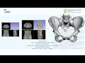 3D Slicer Tutorial Pelvic Bone Segmentation