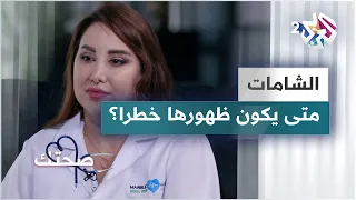 ظهور الشامات الأسباب والأنواع والمخاطر دليل شامل 